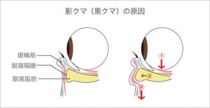 目の下のたるみができる原因の一つには加齢による眼窩脂肪のせり出しがあります