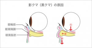 眼窩脂肪が飛び出して黒クマができる原因になる様子を表しています