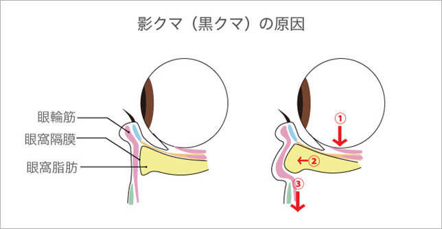 眼窩脂肪が飛び出して黒クマができる原因になる様子を表しています