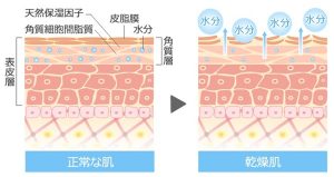 正常な肌と乾燥肌の肌断面図を表しています