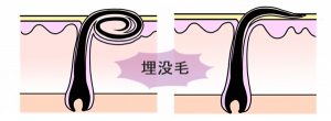 毛が皮膚の表面に出られなくなった埋没毛を表しています