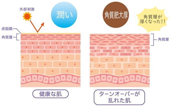 正常な肌と角質肥厚で厚くなった肌の違い